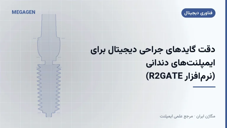 دقت گایدهای جراحی دیجیتال برای ایمپلنتهای دندانی (نرمافزار R2GATE)