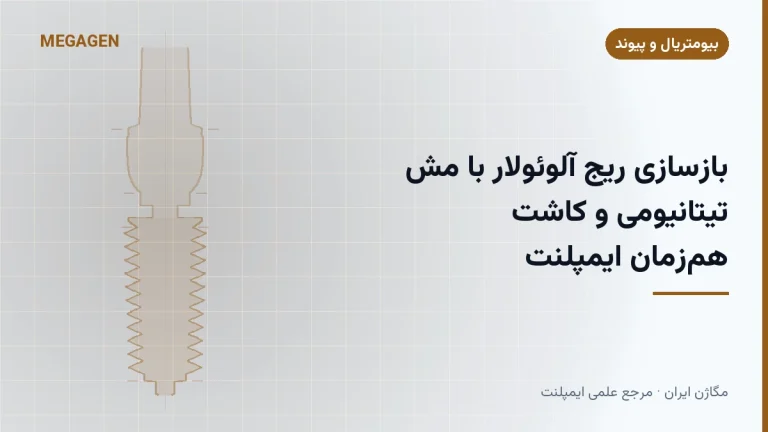 بازسازی ریج آلوئولار با مش تیتانیومی و کاشت همزمان ایمپلنت
