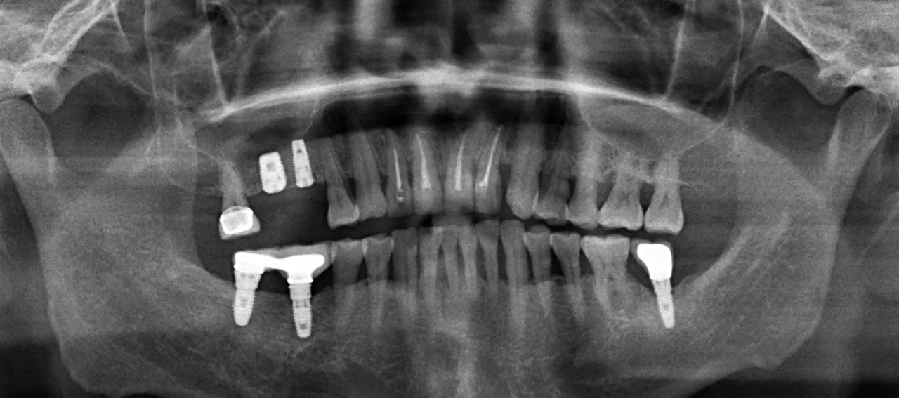 عوارضِ جراحیِ سینوس‌لیفت؛ عواملِ خطر و اصولِ پیشگیری