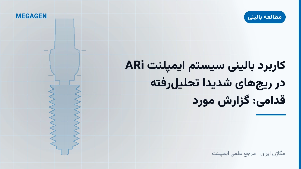 کاربرد بالینی سیستم ایمپلنت ARi در ریج‌های شدیداً تحلیل‌رفته قدامی: گزارش مورد