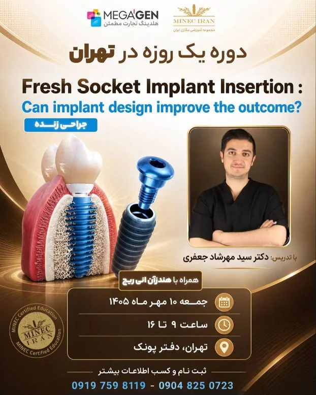 کاشت ایمپلنت در فرش‌ساکت؛ نقش طراحی ایمپلنت در نتیجه درمان